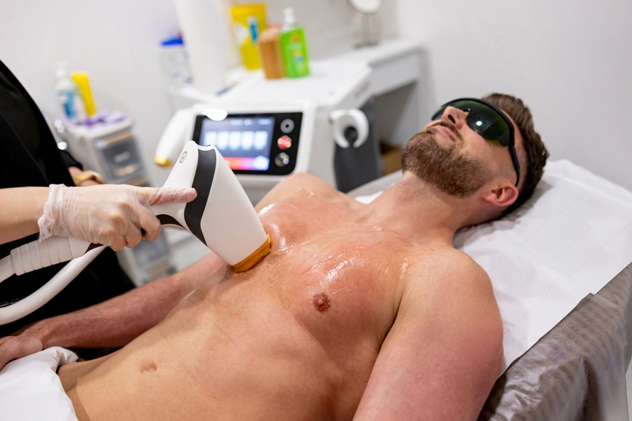 Confidence Unleashed How Laser Hair Removal Empowers Men