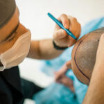 The Secret of Summer: 5 Good Reasons for a Hair Transplant