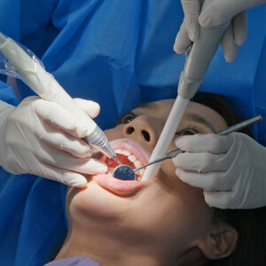 How Teeth Scaling and Polishing Addresses Yellow Teeth