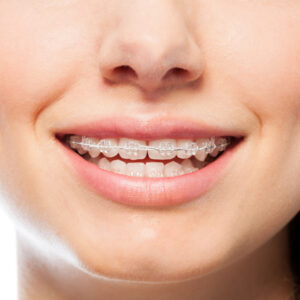 Is the Damon Clear Braces treatment painful