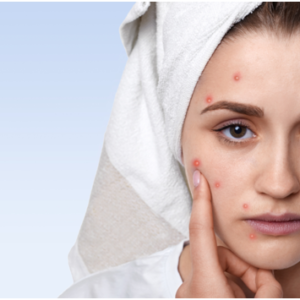 Surprising Causes of Adult Acne