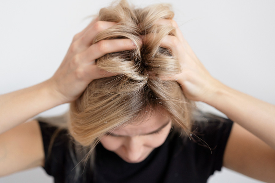 How Stress Can Trigger Both an Itchy Scalp and Hair Loss