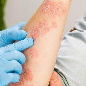 Common Causes Of Skin Rashes And How They are Treated